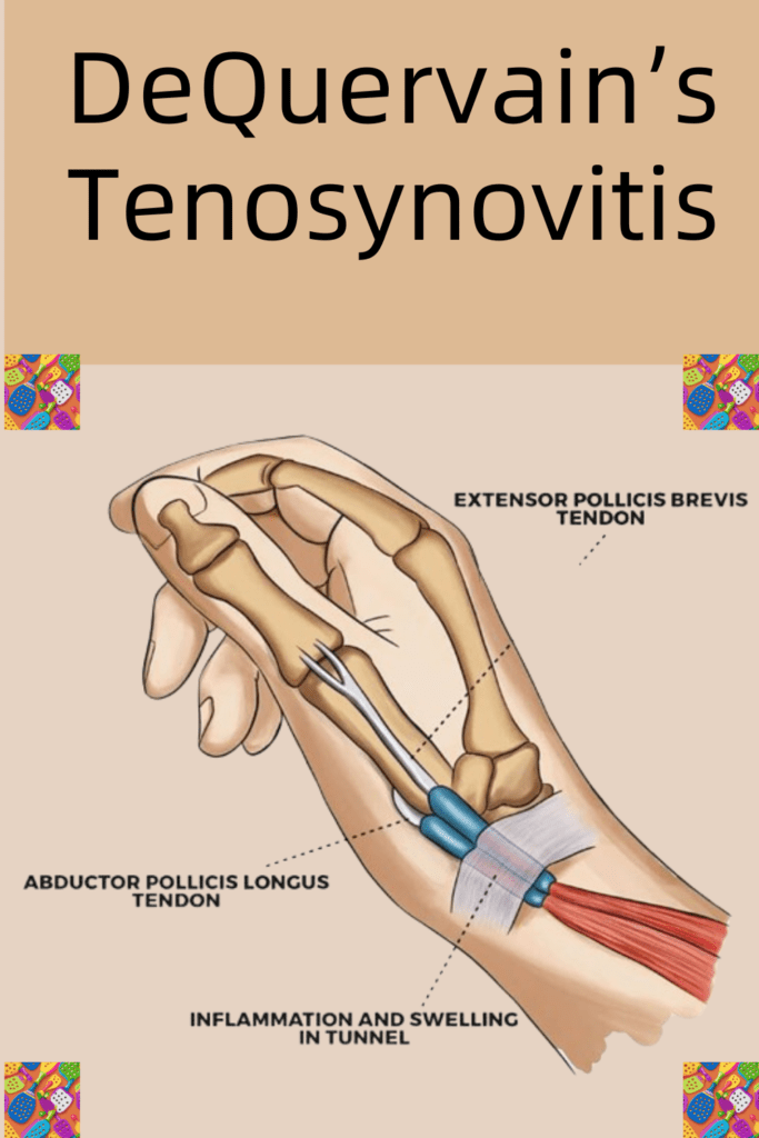 DeQuervain's Tenosynovitis