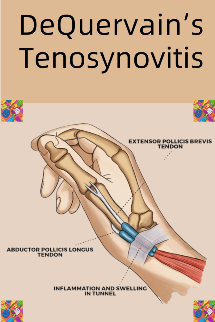 DeQuervains-Tenosynovitis-1 DeQuervain's Tenosynovitis